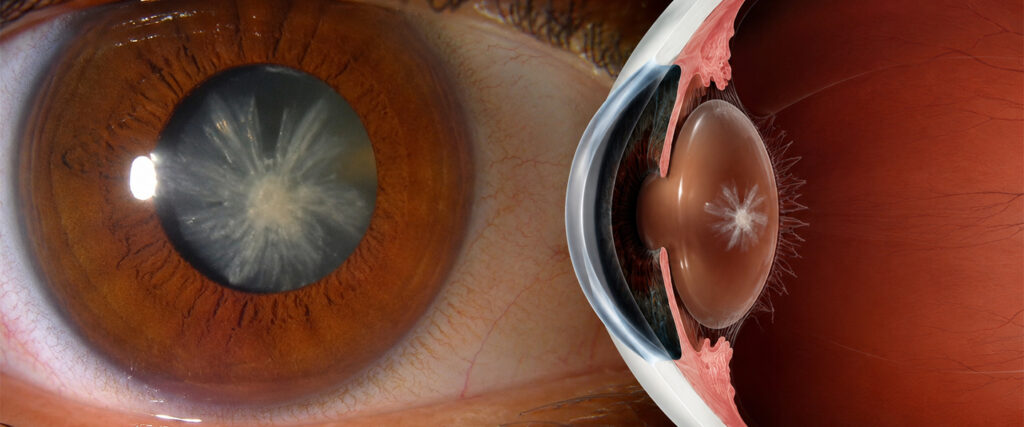 All you need to know about Posterior polar cataract (PPC)