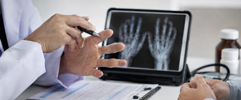 Incorporating Iguratimod in Rheumatoid Arthritis Management: Clinical Considerations and Decision-Making Factors