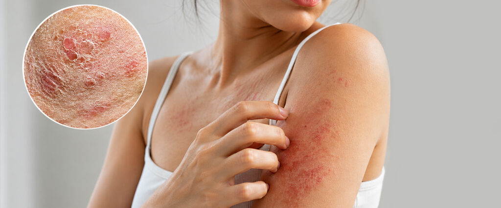 Unravelling the Challenges of Atopic Dermatitis: Effective Management and Modern Treatment Options