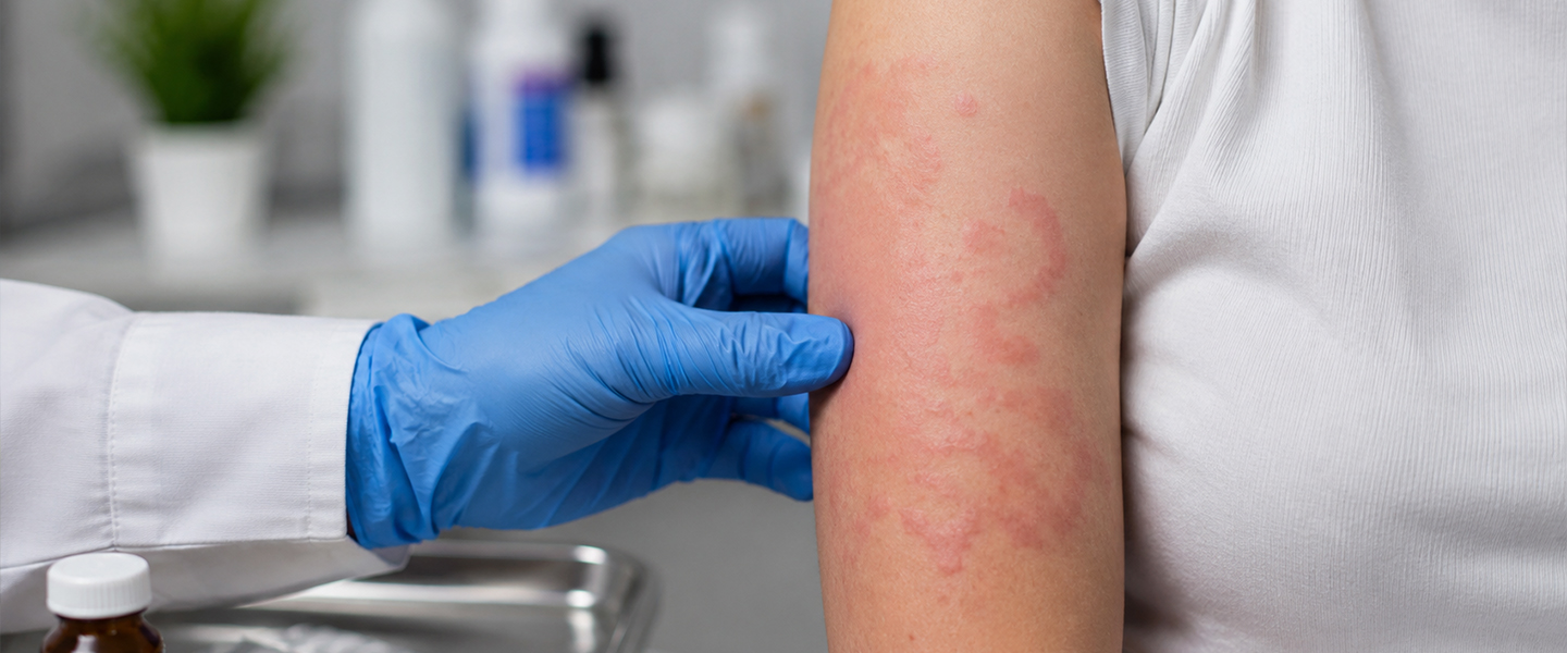 Effective Control of Chronic Spontaneous Urticaria: Insights from Bilastine Case Studys