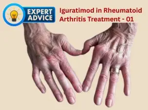 Methotrexate vs Iguratimod: Reconsidering First-Line Strategies in RA Management