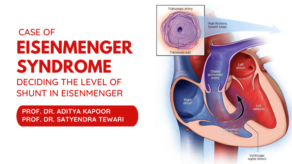 Case of Eisenmenger Syndrome: Deciding the level of shunt in Eisenmenger